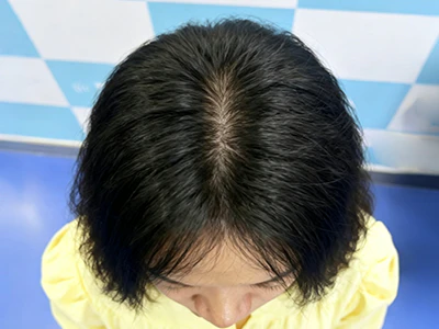 女士髮縫寬大加密後