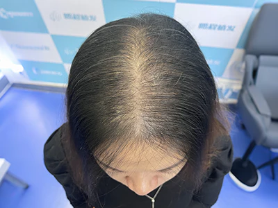 女士髮縫寬大加密前